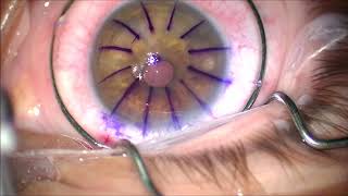 Corneal Transplant PKP for Keratoconus [upl. by Unders]