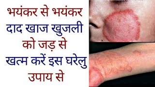 दाद खाज खुजली कितना भी सालों पुराना हो 1 दिन में छुट्टी कर देगा  fungal ringworm treatment [upl. by Onia68]