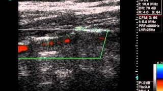 ECHO DOPPLER VERTEBRAL ARTERY FLOWwmv [upl. by Eneluqcaj]