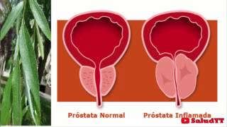 La mejor cura para la próstata en todo el mundo no hay nada mejor [upl. by Clementina]