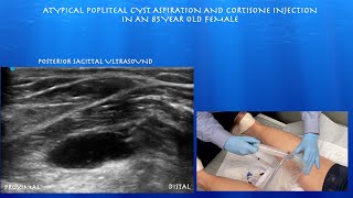 Ultrasound Guided Atypical Popliteal Cyst Aspiration and Cortisone Injection [upl. by Dessma]