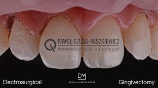 Electrosurgical Gingivectomy  Crown Lengthening [upl. by Kappenne279]