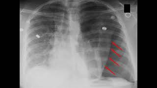 Como se ve neumotorax en radiografia [upl. by Airom]