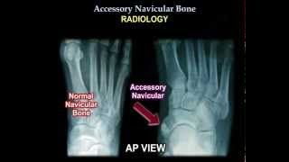 Accessory Navicular Bone  Everything You Need To Know  Dr Nabil Ebraheim [upl. by Ahen395]