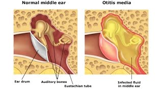 Otitis Media [upl. by Anisah]