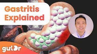 What is Gastritis  The GutDr Explains 3D Gut Animation [upl. by Haelat209]