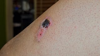 Scab after Burn 🔥 [upl. by Pergrim303]