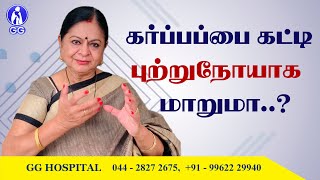 Can uterus fibroids cause cancer  GG Hospital  Dr Kamala Selvaraj [upl. by Littlejohn]