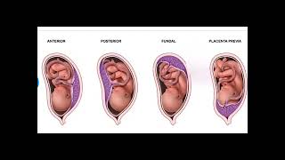 Fetal lateral ventricle measurements How to measure posterior ventricle for ventriculomegaly [upl. by Erdne911]