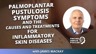 Palmoplantar Pustulosis Symptoms and the Causes and Treatments for Inflammatory Skin Diseases [upl. by Dick491]