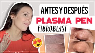 PLASMA PEN FIBROBLAST ANTES Y DESPUES  CarolinaSKB CarolinaTV plasmapen plasmafibroblast [upl. by Hermann]