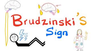 Brudzinskis Sign  Meningitis  Neurology  Physical Exam [upl. by Ashien]