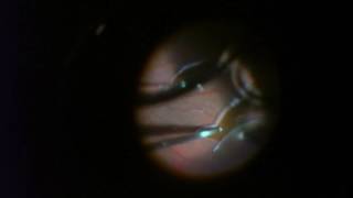 Retinal Detachment Repair  25 gauge Vitrectomy with Gas [upl. by Strait]