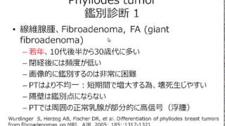 Phyllodes tumor answer 20140707 WMV [upl. by Bruce840]