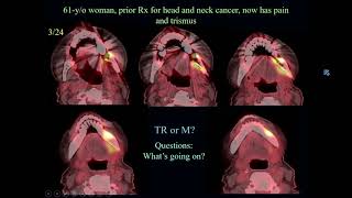 2024 Practical Head amp Neck Imaging Mimics and Casebased Review  A Video CME Teaching Activity [upl. by Asilehs]