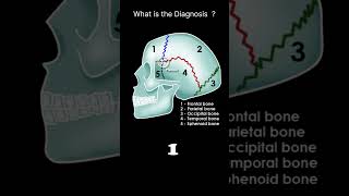 Skull bones and sutures  lateral viewCT Brain Anatomy Skull bones Quiz 3radiologychannel007 [upl. by Cassondra238]