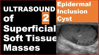 Epidermoid inclusion cyst on Ultrasound [upl. by Jaine]