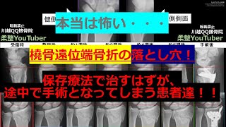 手首骨折橈骨遠位端骨折の治療途中で手術になる事例 全国民必見！ [upl. by Alliuqat386]