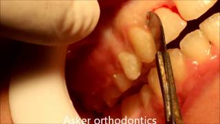 Circumferential supracrestal fiberotomyCSF in rotated teeth after finishing orthodontic treatment [upl. by Atteynek393]