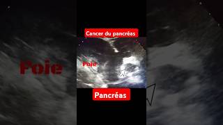 Échographie abdominale cancer pancréas processus tumorale corporeocaudale du pancréas pancréas [upl. by Konikow]