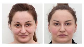 The results of dermal fillers before and after [upl. by Dolorita679]