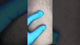 Watch Electrolysis Now Zap Hairs with Me [upl. by Jodoin]