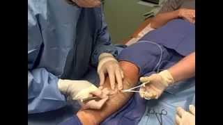 Ambulatory Phlebectomy Vein Removal  Skinovative and Center for Venous Disease [upl. by Ecirp764]