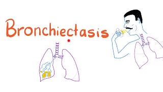 Bronchiectasis [upl. by Dessma]