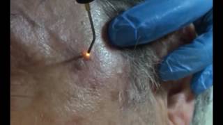 Plasmage  Treatment Fibroma Lentigo [upl. by Magena28]