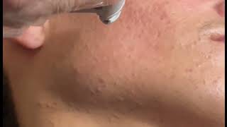 Hair removal on Candela GentleLASE dermalab skincare dermetologist hairremoval skin laser [upl. by Ennaed]