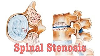 Spinal Stenosis  Surgery vs Chiropractic Care [upl. by Nadoj]