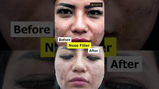 Nose Filler  Nose Filler treatment  Nose Filler cost  Nose Filler treatment Video [upl. by Roxanne]