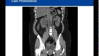 Medical Expulsive Therapy for Ureteral Stones [upl. by Pierrette]