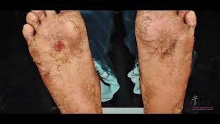 BEEP CARE HINDI  LYMPHATIC FILARIASIS  ELEPHANTIASIS  HAATHI PAAV  INTEGRATIVE TREATMENT  IAD [upl. by Aerehs]