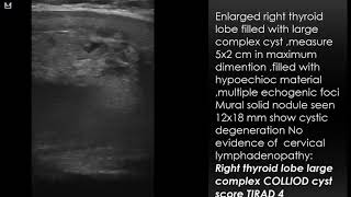 CASE 622 LARGE COMPLEX THYROID COLLIOD CYST TIRAD 4 [upl. by Aiekam317]