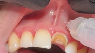 Local Anesthesia For Extraction Upper Central incisor  anterior superior and nasopalatine nerve [upl. by Elohcin]