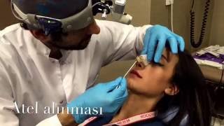 After Rhinoplasty  Volume 1 Cast Removing [upl. by Ttereve]