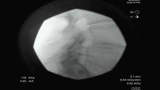 Fluoroscopic lumbar epidural injection lateral contrast spread [upl. by Samantha]