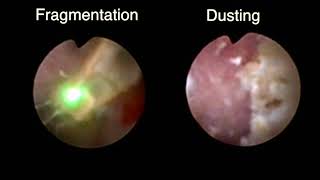 fURS Dusting vs Fragmentation Holmium laser lithotripsy [upl. by Kreitman]