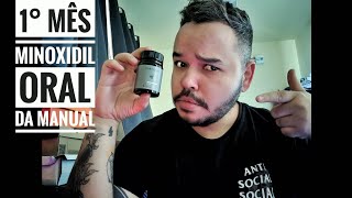 🔴 1 Mês de Minoxidil Oral da Manual Comprimido 💊  O que mudou É Bom [upl. by Pia]