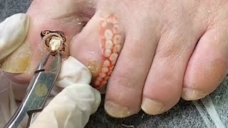 DEEP SATISFYING Callus CORN REMOVAL  Do this and the callus will go away [upl. by Enytsirk340]