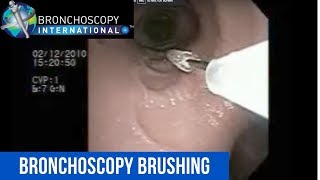 Flexible Bronchoscopy Basic Techniques 5  Brushing [upl. by Berti]