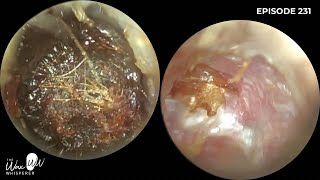 231  Removing earwax off the eardrum amp embedded keratin from retraction pocket using WAXscope [upl. by Damon]