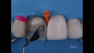 direct composite veneers with layering technique [upl. by Harley]