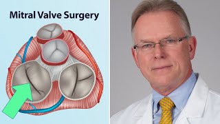 Mitral Valve Surgery What Should Patients Know Interview with Dr Vaughn Starnes [upl. by Nana]