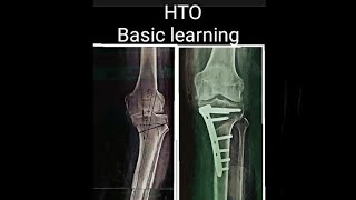 HTO for beginners Part 1Basic HTOFujisawa pointLearning High tibial osteotomy [upl. by Hannaoj]