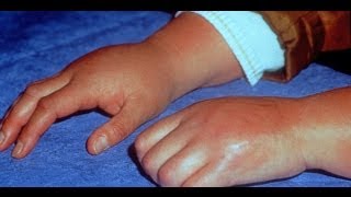 Learn About Reflex Sympathetic Dystrophy  Also Known as Reflex Pain [upl. by Lathe]