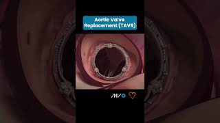 🫀Transcatheter Aortic Valve Replacement TAVR 🫀 [upl. by Yuria765]