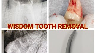 HOW TO REMOVE WISDOM TOOTH AND RCT TREATED TOOTH USING COUPLAND ELEVATOR [upl. by Itsim]