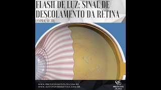 Flash de luz e descolamento de retina [upl. by Earlene]